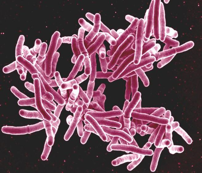 Preocupación por tuberculosis resistente a medicamentos en Suramérica